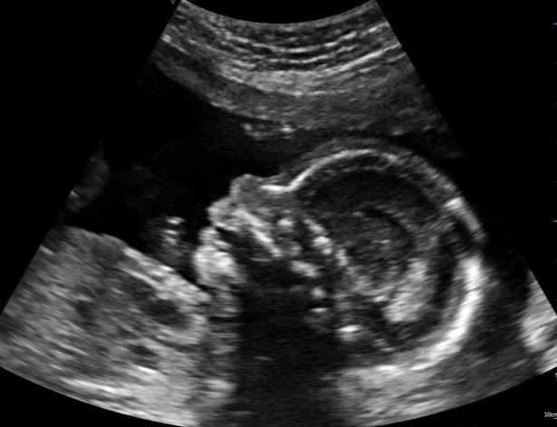 Ultraschallbild von Profil Babygesicht